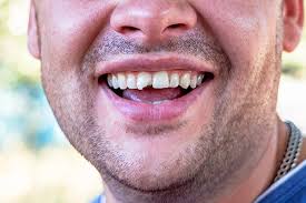 Fort Wayne, patient with broken tooth