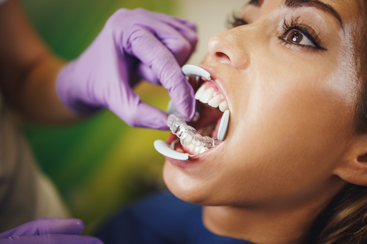 first Invisalign experience in Fort Wayne - Family Dentistry