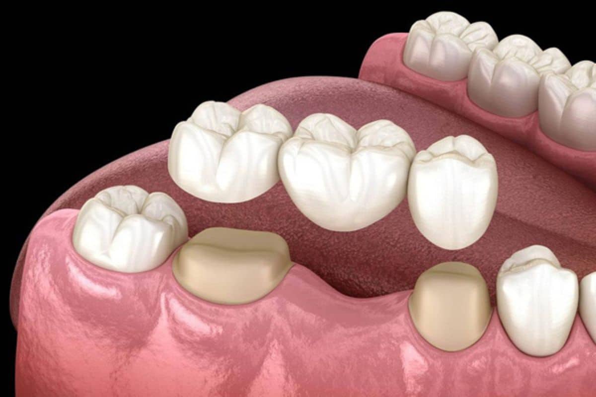 Preparing for Dental Bridges in Fort Wayne IN at Family Dentistry