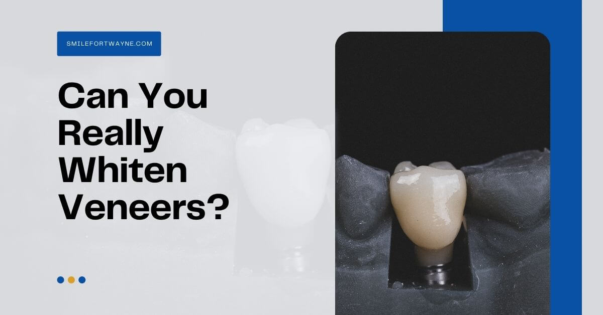 Can you really whiten veneers?