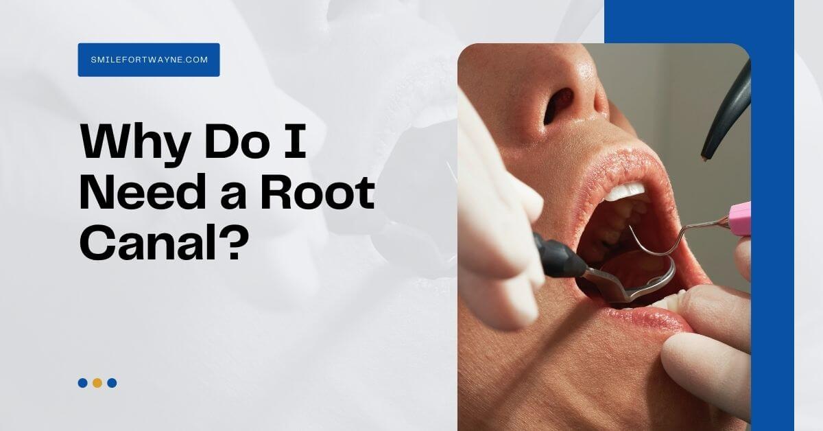 why do i need a root canal