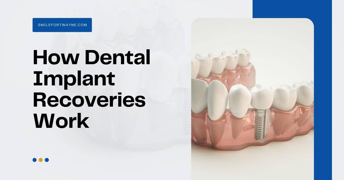 How dental implant recoveries work