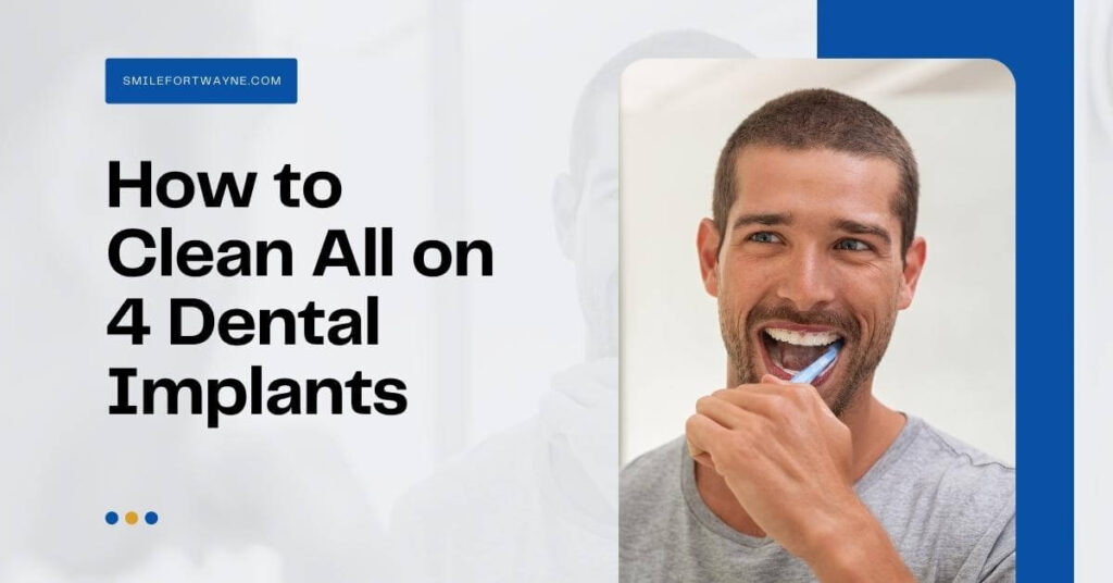 How to Clean All on 4 Dental Implants