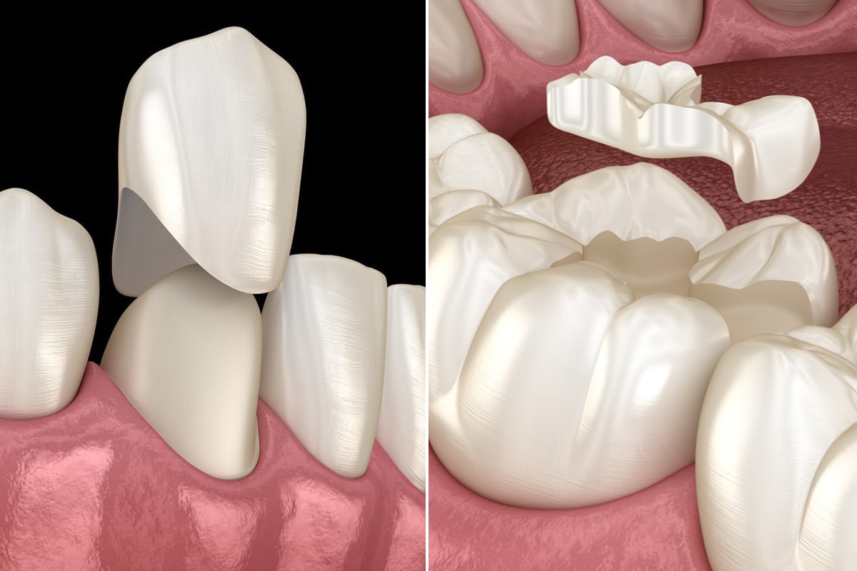 Difference Between Dental Crowns