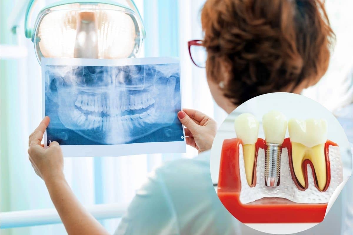 Can dental implants cause cancer? - Family Dentistry & Aesthetics in Fort Wayne IN