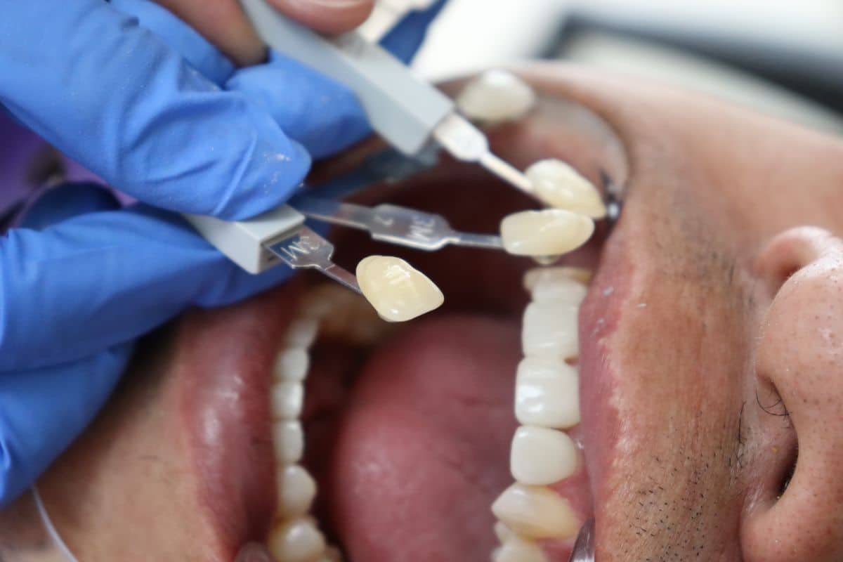 Can You Get Veneers on Dental Crowns? - Family Dentistry