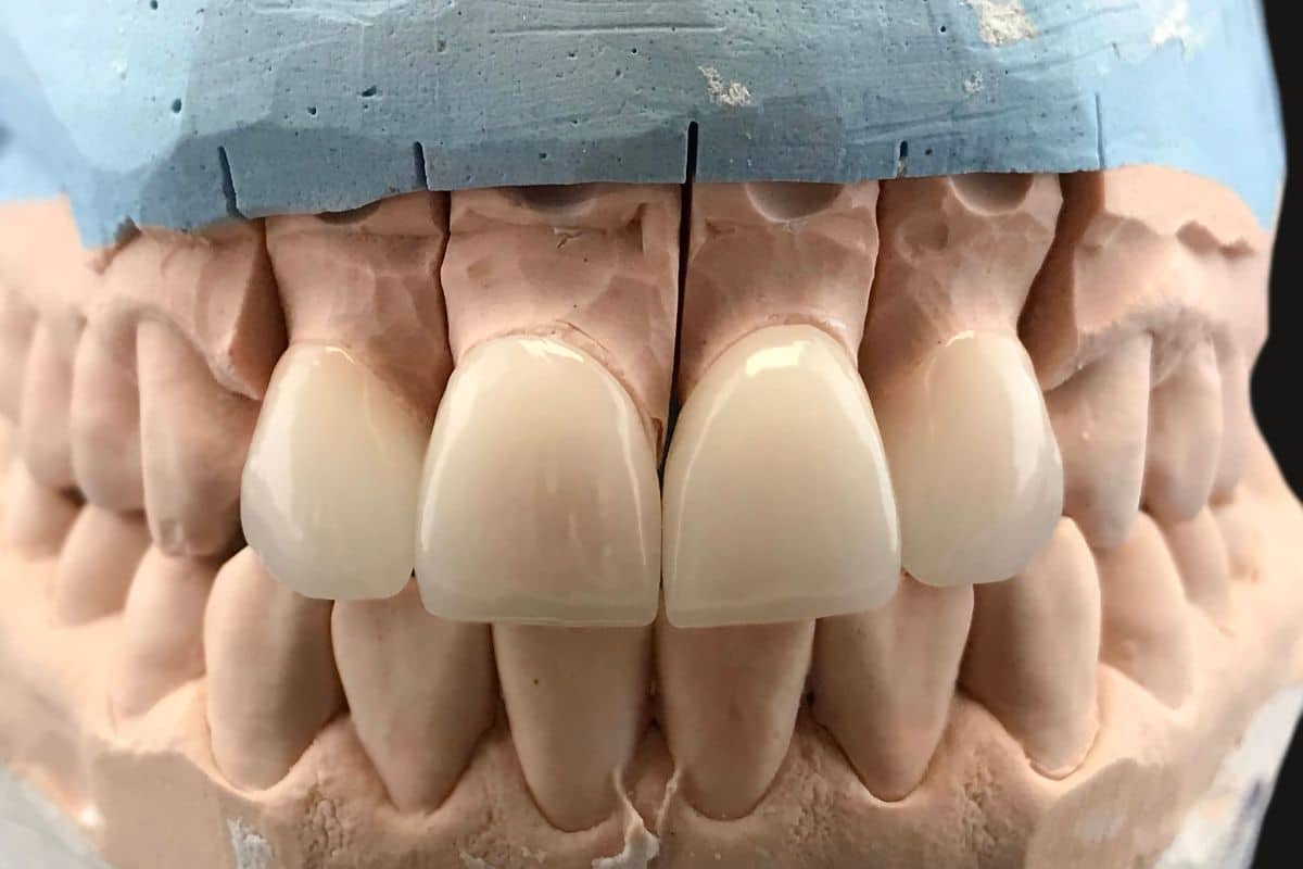 About Composite Veneers - Family Dentistry