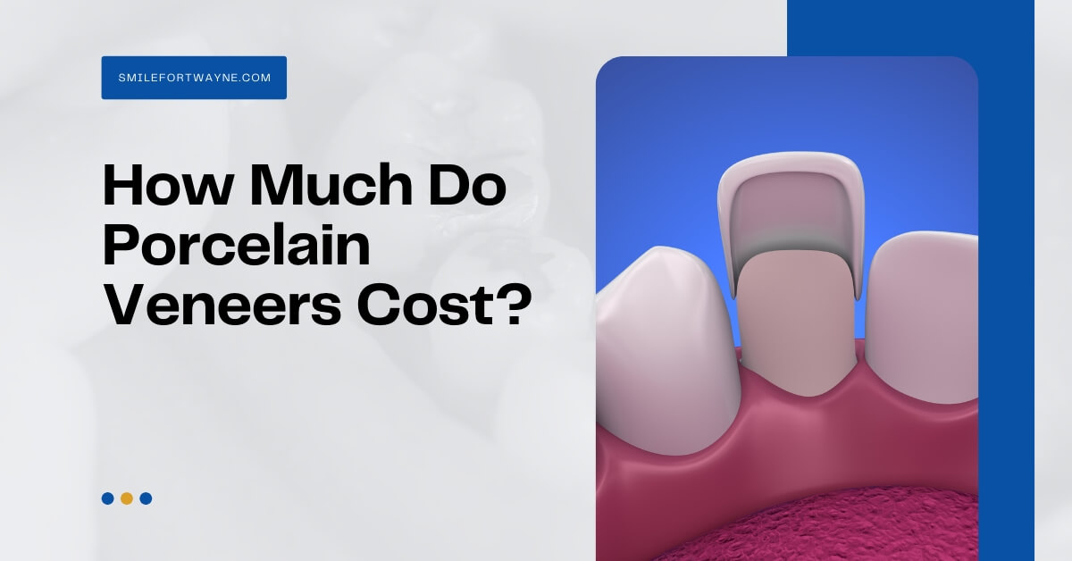How Much Do Porcelain Veneers Cost_