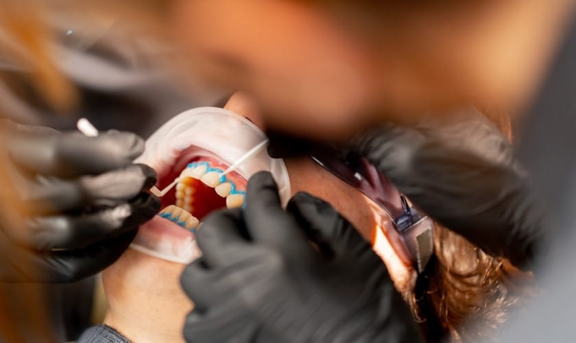 Dental Filling