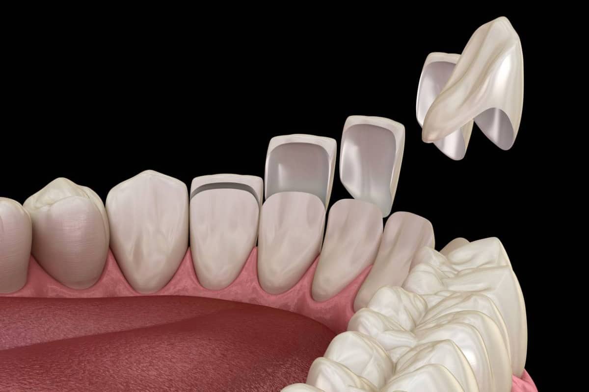 Dental veneers displayed on tooth model showing smile transformation before and after placement.