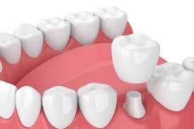 3D dental illustration showing tooth implant procedure with white teeth and pink gum model