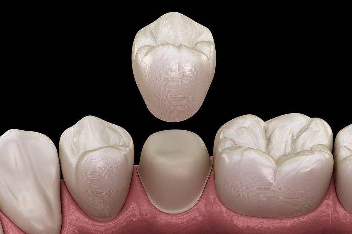 Dental crown restoration showing ceramic tooth implant placement above gum line in clinical setting.
