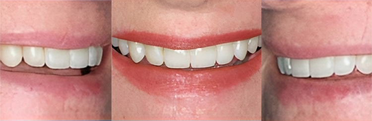 Three close-up views of different smiles showing dental work and tooth alignment results.