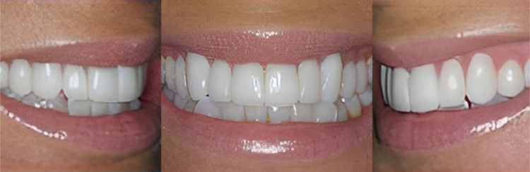 Three close-up dental photos showing before and after teeth whitening results with improved brightness and shade.