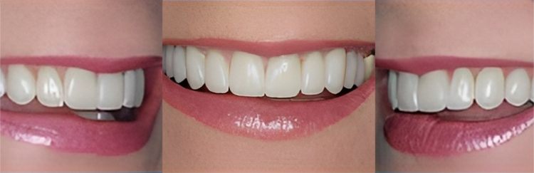 Three close-up views of bright, white teeth and smiles demonstrating professional dental results.