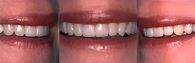 Three close-up views of different smiles showing teeth whitening and cosmetic dental results.