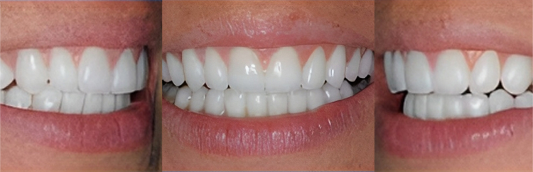 Three close-up views of white dental veneers on natural teeth displaying smile results.