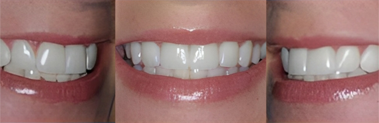 Three close-up views of natural teeth and smile results from dental treatments.
