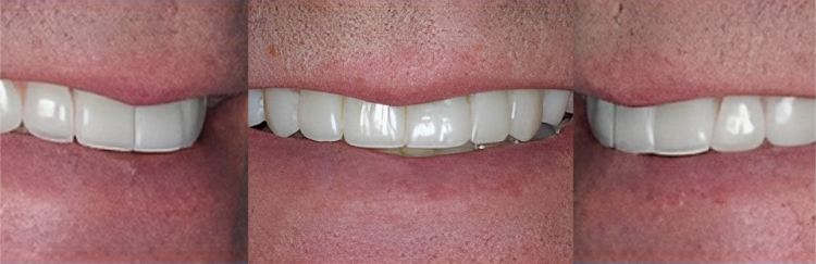 Three close-up views of white dental veneers on upper front teeth showing smile results.