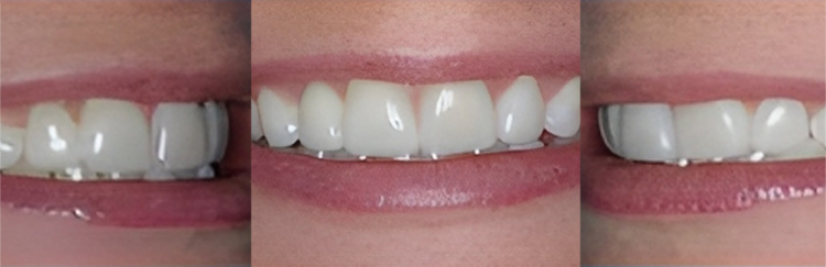 Three close-up views of teeth whitening results showing before and after dental treatment outcomes.
