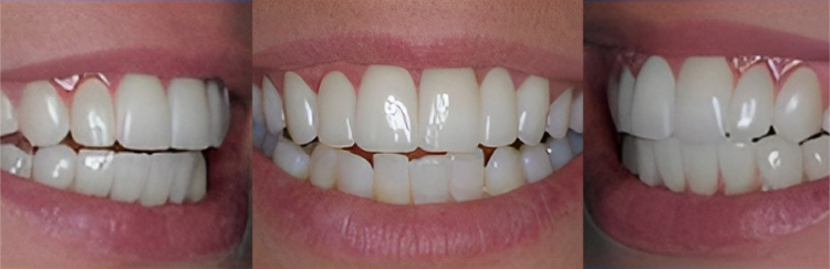 Three close-up views of white teeth showing dental work results and smile aesthetics.