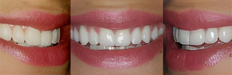 Three close-up views of smiling teeth showing dental whitening results and cosmetic dental work.
