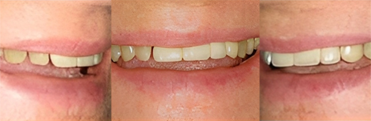 Three close-up views of teeth showing dental treatment results and smile improvements.
