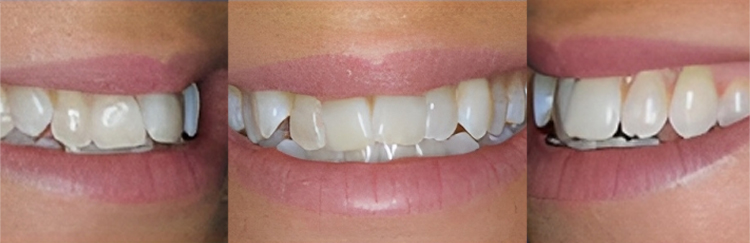 Three dental smile transformations showing before and after teeth whitening and cosmetic dental results.