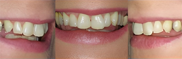 Three close-up views of patient smiles showing before and after dental treatment results.