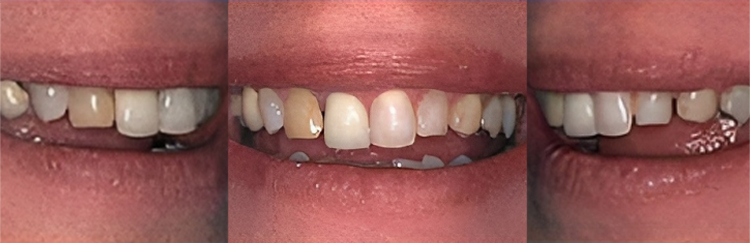 Three close-up views of teeth showing before and after dental treatment results.