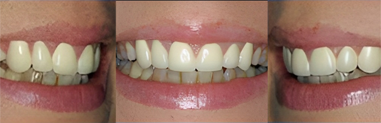 Three closeup views of teeth showing dental work and smile improvement results.