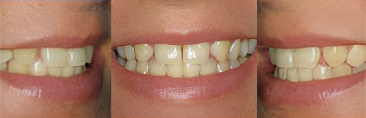 Three close-up views of teeth showing before, during, and after cosmetic dental treatment results.