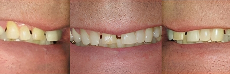 Close-up of teeth showing dental discoloration and alignment issues before treatment.