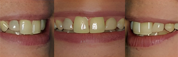 Three close-up views of teeth showing dental discoloration and spacing issues before treatment.