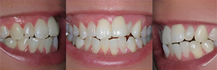 Three dental closeup images showing teeth alignment and smile improvement before and after treatment.