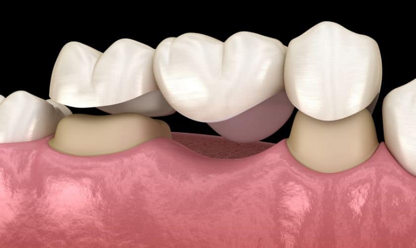 Do dental bridges require special care and maintenance