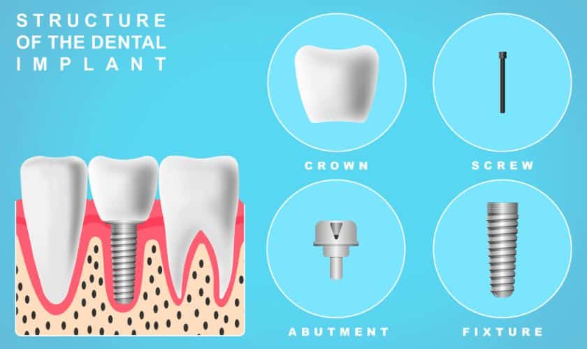 Dental Implants - Family Dentistry