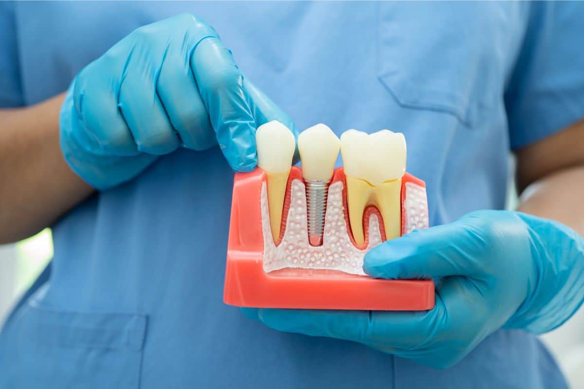 Dental Implants in Fort Wayne, IN - Family Dentistry