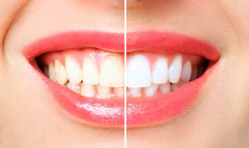 Teeth Whitening Richmond TX - BLVD Dentistry