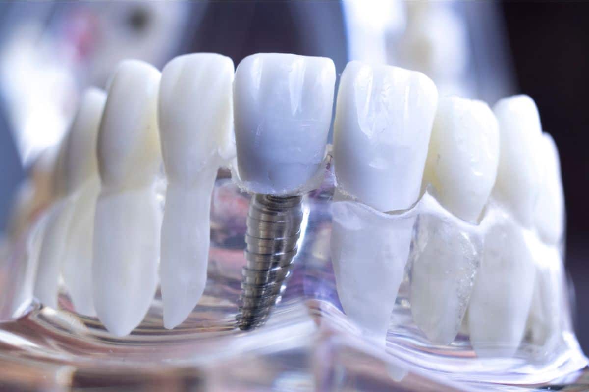 Dental Implants - Dentist in Fort Wayne, IN at Family Dentistry