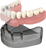 Dental implant model showing tooth replacement procedure with prosthetic teeth on jawbone structure.