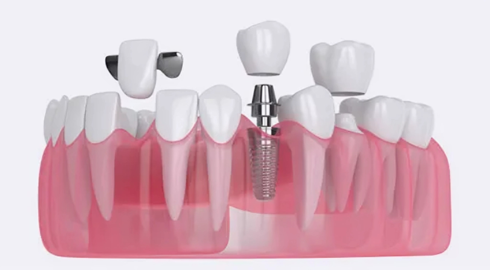 Dental implant model showing tooth replacement procedure with crown and implant components on pink gum base.