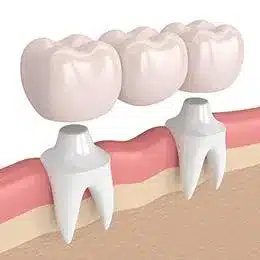 Dental implant illustration showing tooth structure, bone integration, and three replacement teeth in cross-section.