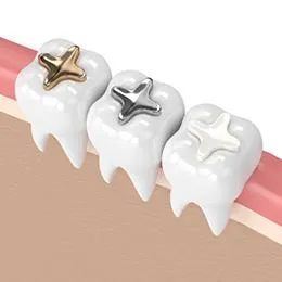Three white tooth models with different crown options: gold, silver, and tooth-colored, displayed on pink gum model.