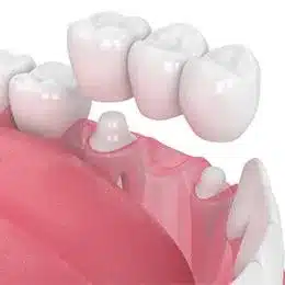 Dental crown placement illustration showing tooth restoration procedure with ceramic crowns on pink gum model.