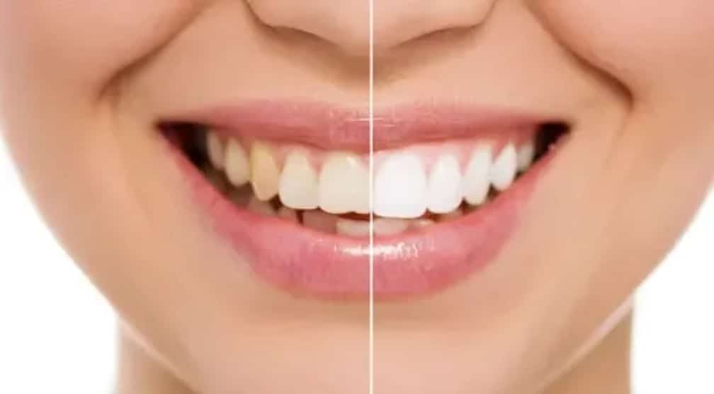 Before and after smile comparison showing teeth whitening results on left and right sides.