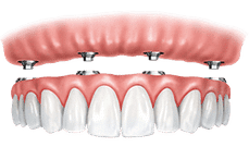 Digital illustration of dental implants with gum tissue and prosthetic teeth crown placement.
