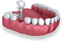 Dental implant model showing screw-in tooth replacement in gum tissue demonstration.