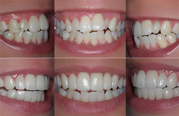 Six close-up views of teeth showing before and after cosmetic dental treatment results.