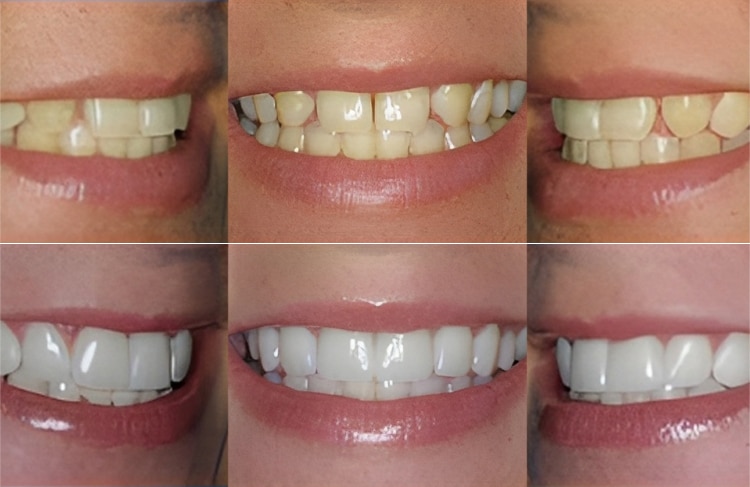 Before and after dental whitening treatment results showing six smiles with improved tooth brightness and whiteness.